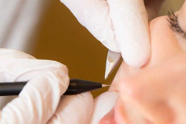 Épilation électrique définitive (thermolyse) à Marseille – Villa M